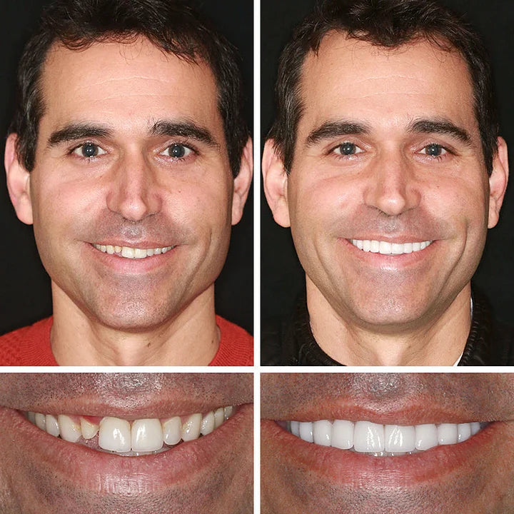 🦷 DarkFairy™ Medical Full Denture with Strong Suctiond Custom-Fit Full Functional Dentures 🦷