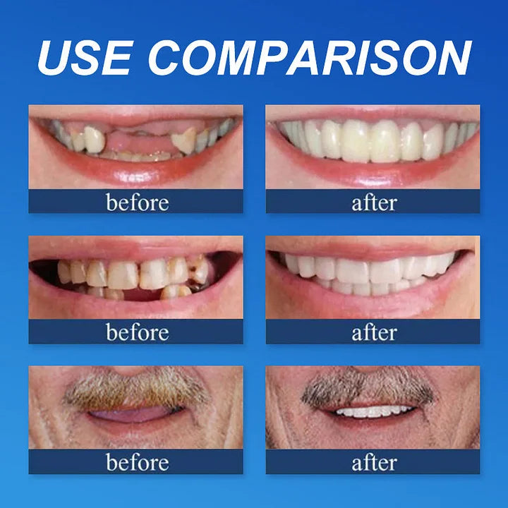 👑2026 Eaily Hot Sale Ends Today: 70% OFF! Luna Cipher Custom Custom-Fit Full Functional DenturesMake you more confident – Made in the USA