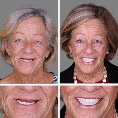 🦷 DarkFairy™ Medical Full Denture with Strong Suctiond Custom-Fit Full Functional Dentures 🦷