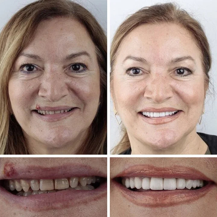 Ends Today: 70% OFF! ⏰DarkFairy™ Medical Full Denture with Strong Suctiond🦷