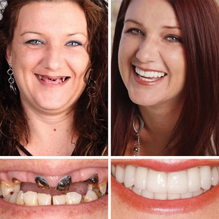 🦷 DarkFairy™ Medical Full Denture with Strong Suctiond Custom-Fit Full Functional Dentures 🦷