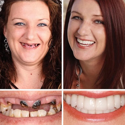🦷 DarkFairy™ Medical Full Denture with Strong Suctiond Custom-Fit Full Functional Dentures 🦷